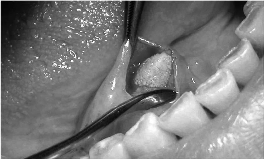 36岁女子一吃饭下巴就痛,这是什么怪病?医生:嘴巴里有个石头