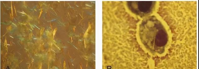 痛风石破溃了怎么能取出痛风石,痛风石破溃后怎么办