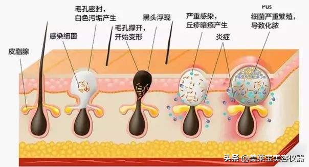 黑头粉刺清除神器仪器,黑头粉刺闭口清理神器