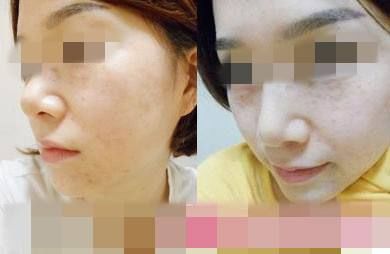 面部微整形的危害,为什么微整形面部变残