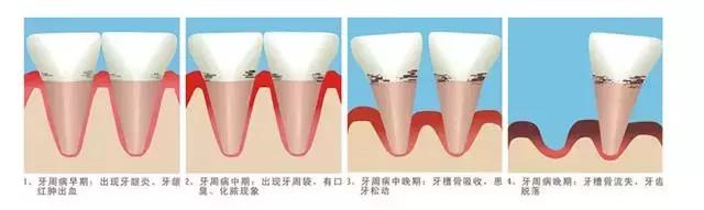 吃肉就塞牙怎么治疗,一吃东西都塞牙