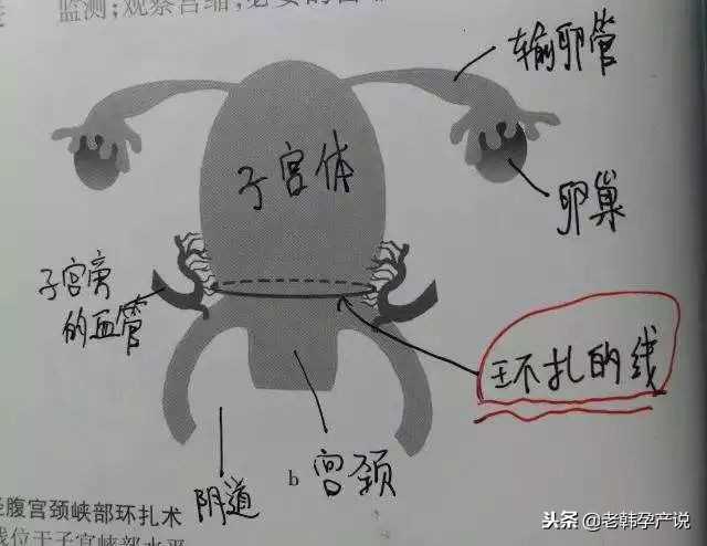 有习惯性流产史备孕怎么调理,孕27周如果有先兆性流产怎么办