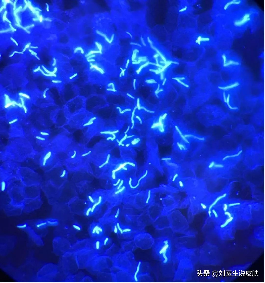 错把体癣当湿疹怎么办,错把湿疹当癣治疗越来越严重