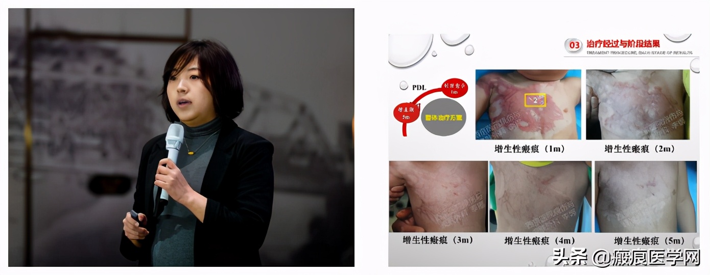 鐦㈢棔妗堜緥,鐤ょ棔娌荤枟鎴愬姛妗堜緥