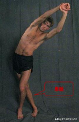 老生常谈跑步膝：髂胫束综合征（ITBS）