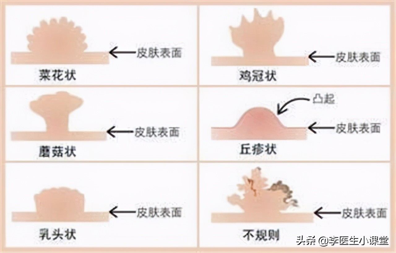 怎么预防淋病传染给家人,高锰酸钾可以预防淋病么