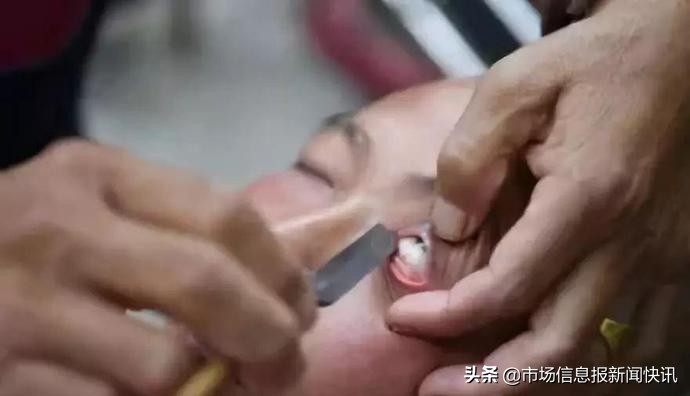 成都刀锋洗眼洗出虫子,刀锋洗眼可以做吗