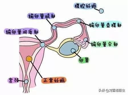 宫外孕后再备孕要注意什么,宫外孕手术后如何避免再次宫外孕