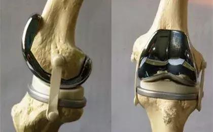 关于膝关节疼痛你一定有好多疑问,类风湿性关节炎患者常见问题解答