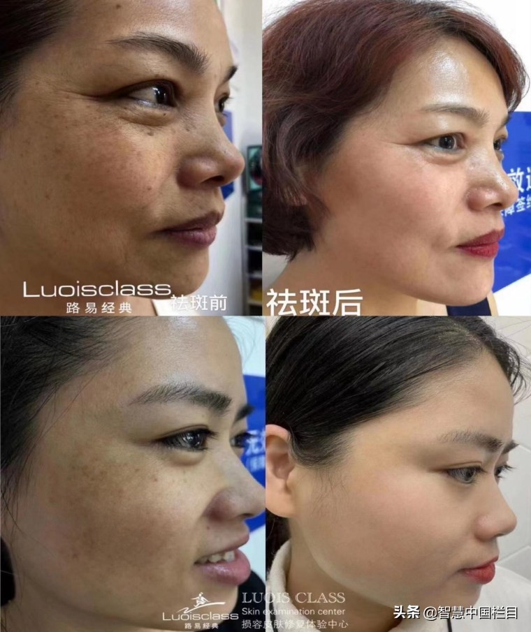 祛斑哪个品牌的最好,祛斑哪个连锁店最有名