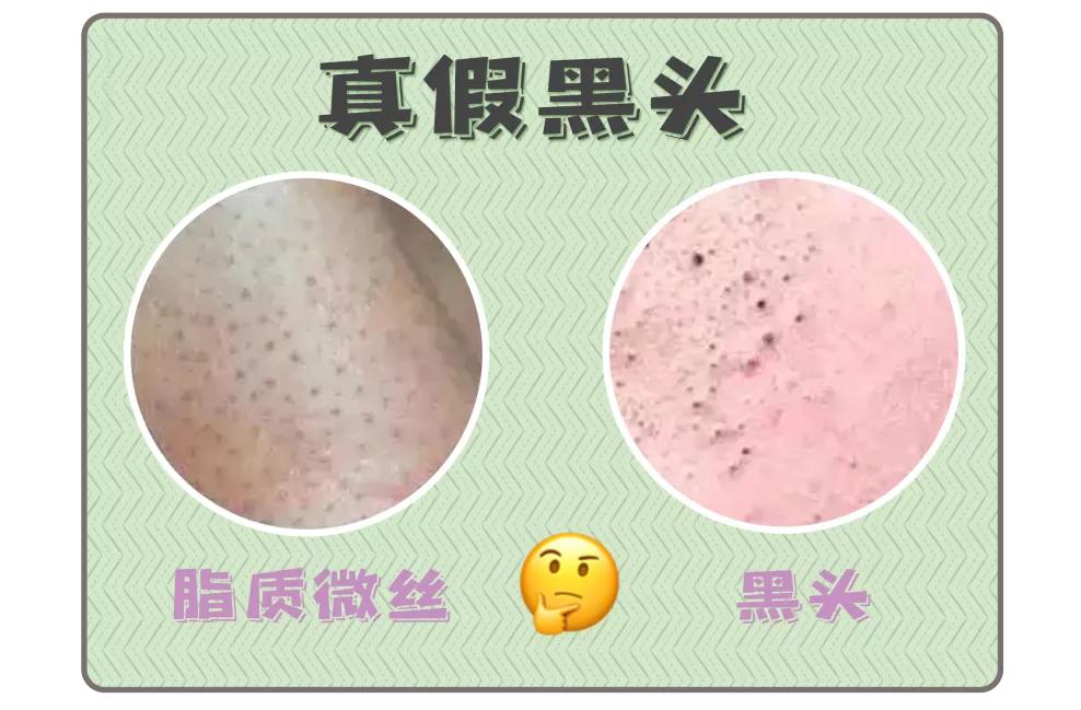 去黑头最好的方法不会再有黑头,如何用简单的方法去黑头真实有效