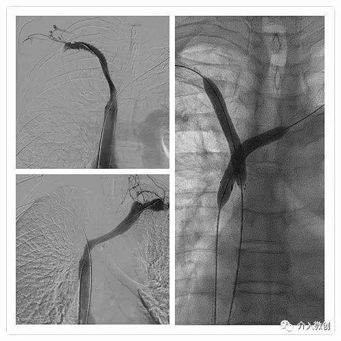 上腔静脉阻塞可以搭支架吗,上腔静脉支架植入大概多少钱