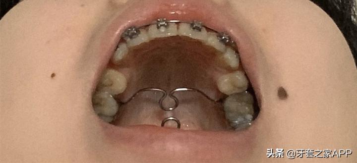 不靠整容怎么改变下巴后缩？看这里