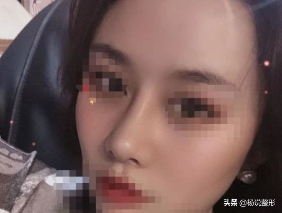 隆鼻整容老了会怎么样,隆鼻后老了