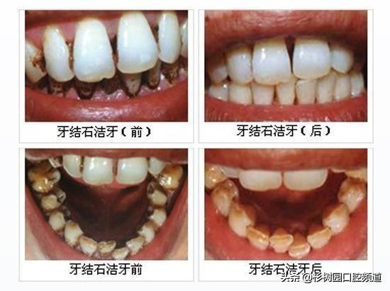 pmtc洗牙和普通洗牙有什么区别吗,39.9洗牙和150洗牙有什么区别