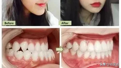 儿童牙齿矫正后要终身戴保持器吗,牙齿矫正戴保持器后还需要复诊吗