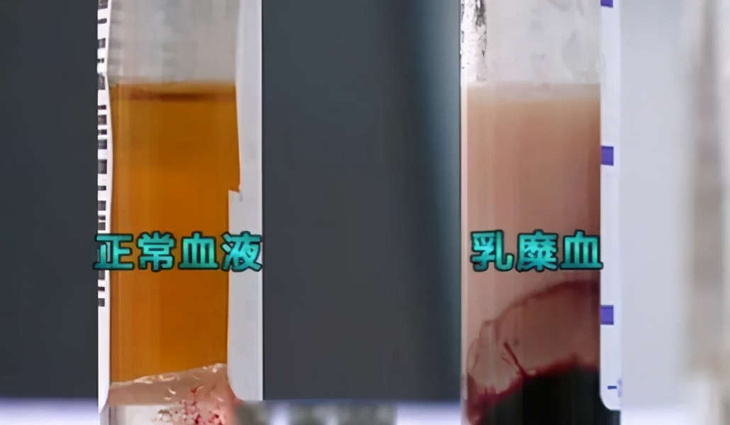 重症急性胰腺炎出icu住院怎么治疗,急性重症胰腺炎进icu治疗手段