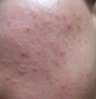 芦荟胶祛痘不祛痘,芦荟胶祛痘淡化痘印