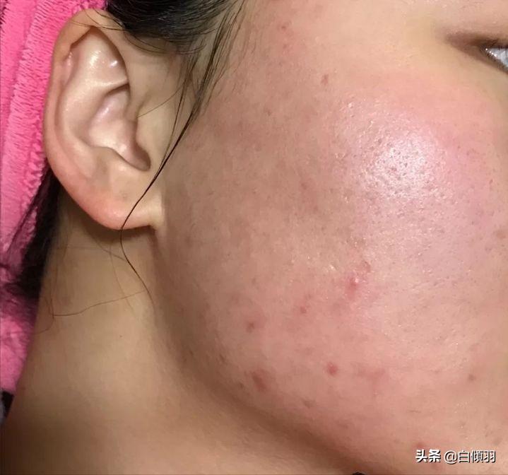 痘痘红肿发硬但是没白色脓头很疼,红肿痘痘疼不冒头也不消怎么办