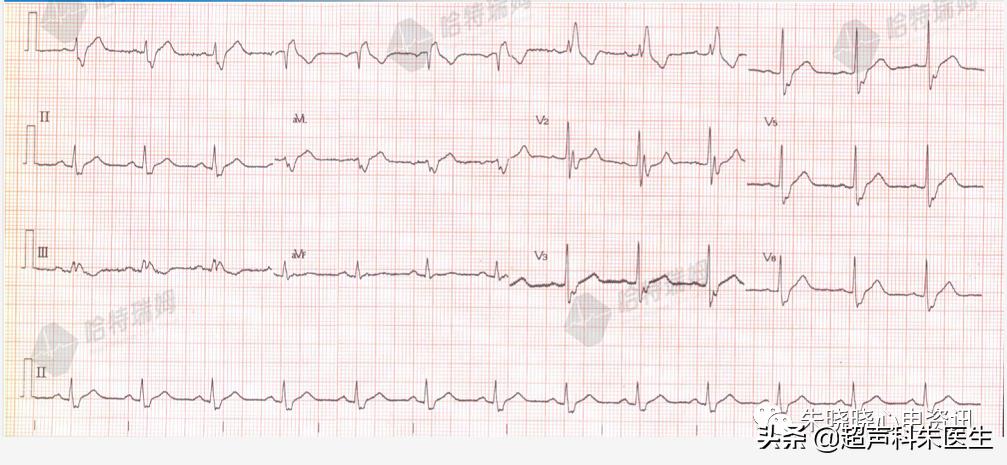 t波倒置诊断,t波倒置如何区分严重程度