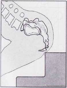 尾骨骨裂弯腰痛,尾骨骨折腰痛酸正常吗