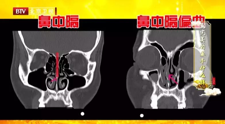 鼻出血可能是血液疾病不容忽视,鼻出血要警惕