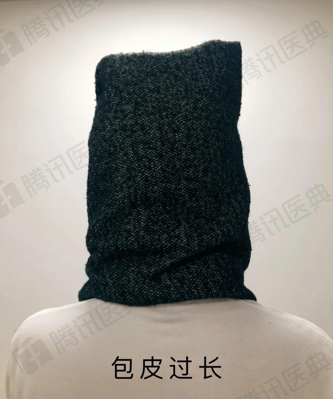 割包皮有割短的情况吗,割包皮有可能割短吗