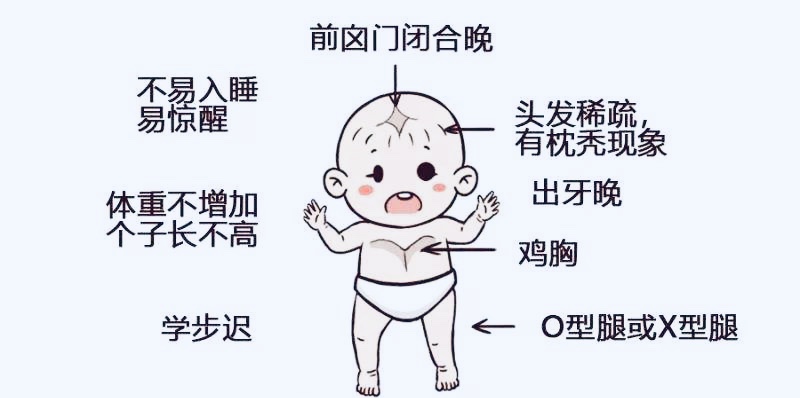 佝偻病需要矫正吗,严重的佝偻病可导致幼儿骨骼畸形