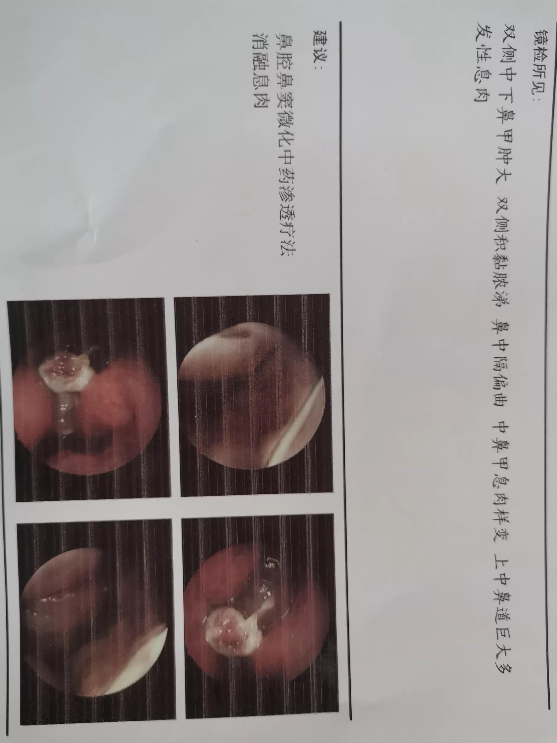 与鼻炎做艰苦斗争,和鼻炎抗争的小何