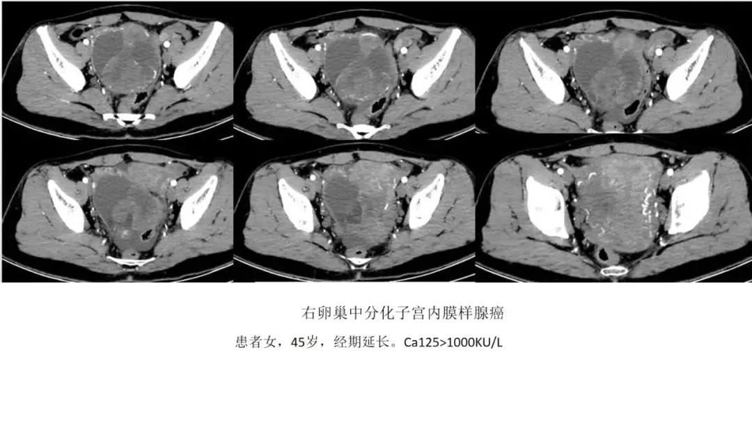 卵巢原发肿瘤的分析思路