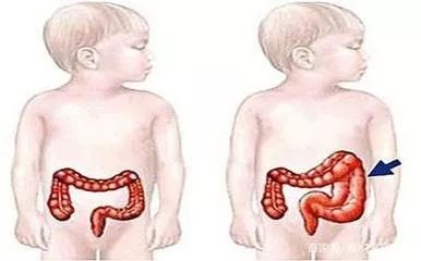 腹腔镜下全结肠根治性切除术,先天性巨结肠腹腔镜手术