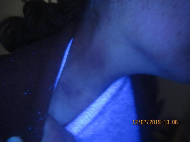 从确诊到康复,仅4个月,颈部白癜风患者王女士分享成功经验