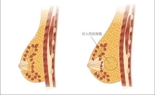 自身脂肪丰胸术后注意什么,自体脂肪的丰胸方法
