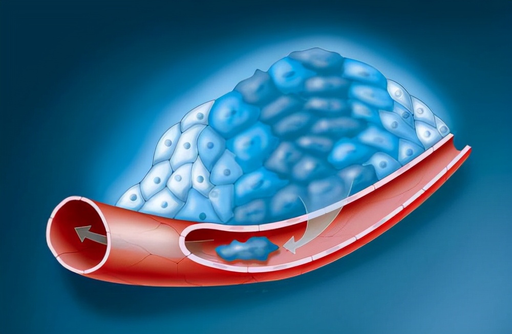 高脂血症中医案例,中医治疗胆固醇高效果