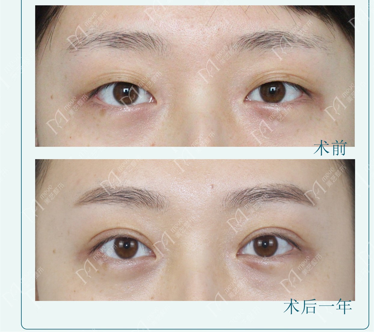 三眼皮显老气吗,三眼皮真的很好看吗