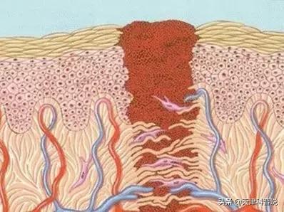 伤口结痂后特别特别的痒是为什么,结痂的地方奇痒难忍为什么