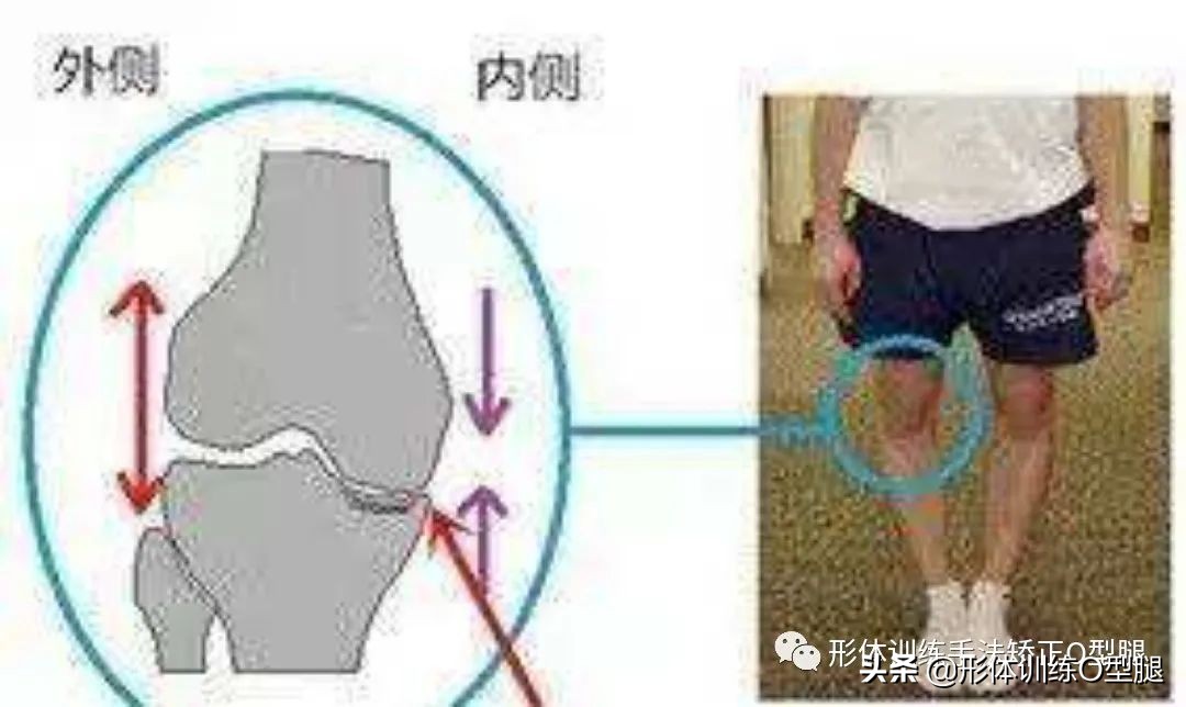 矫正O型腿的动作,o型腿矫正正确方法
