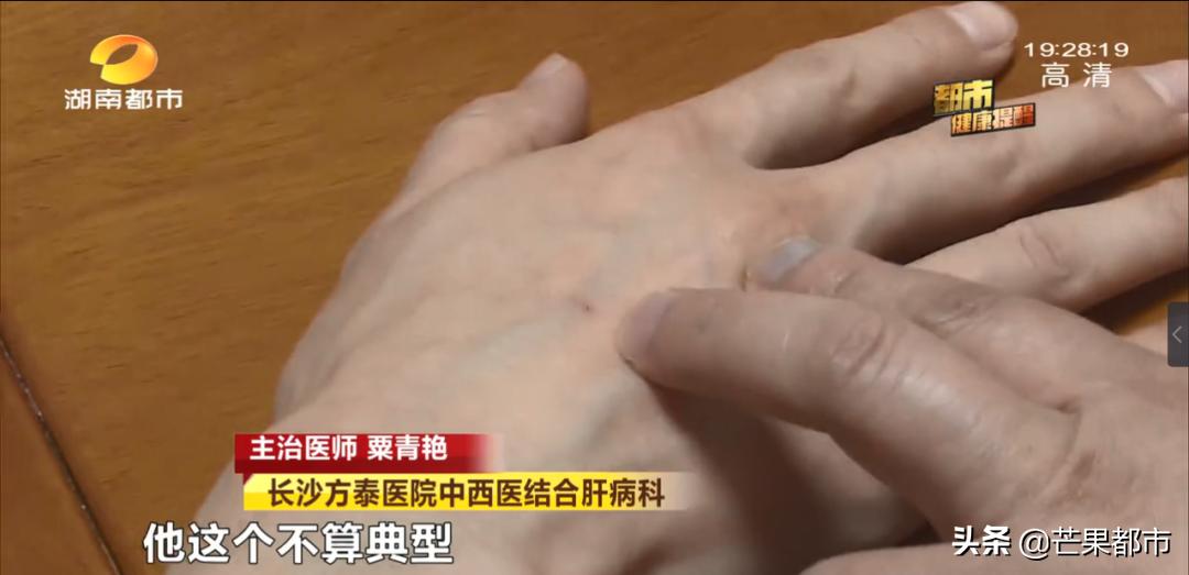 身上长这3种痣要警惕,身体上有这种痣要当心