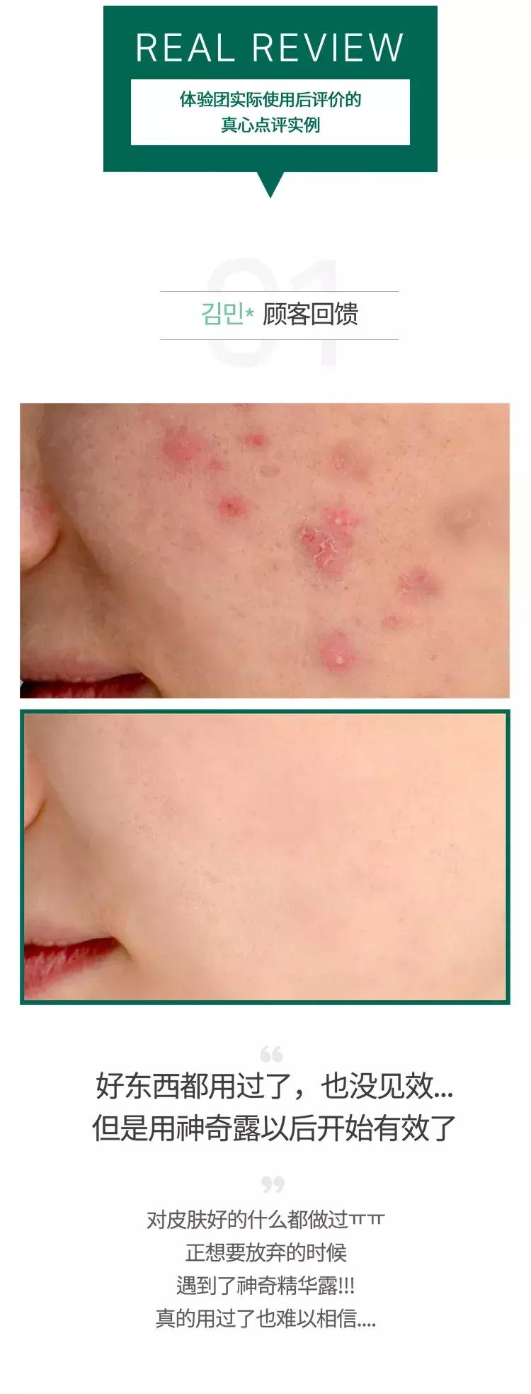 somebymi茶树精华测评,somebymi茶树精华能淡疤吗