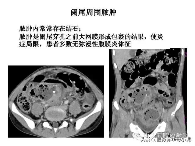 阑尾炎课件,阑尾炎的超声课件