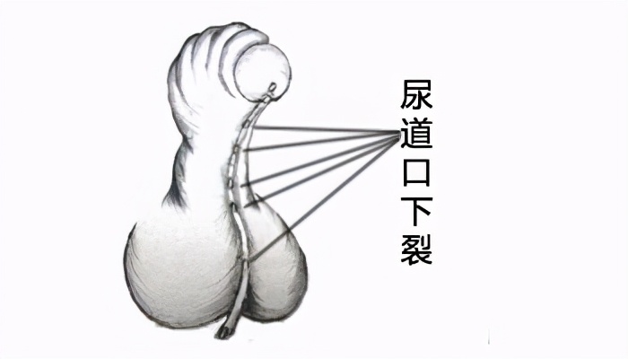 尿道下裂是啥样的,尿道下裂都有什么类型