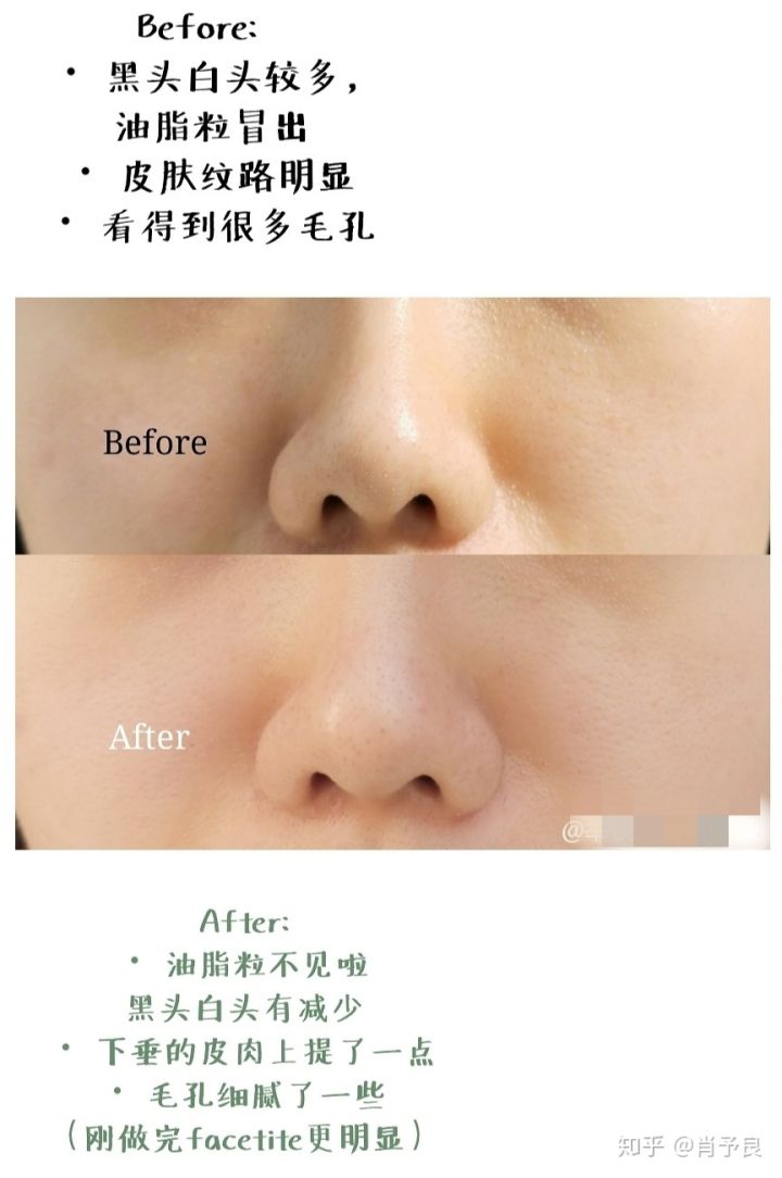 男士祛黑头推荐,祛黑头粉刺过程