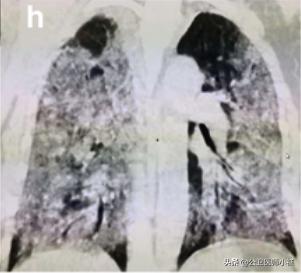 新型冠状病毒感染的肺炎患者肺部影像学改变
