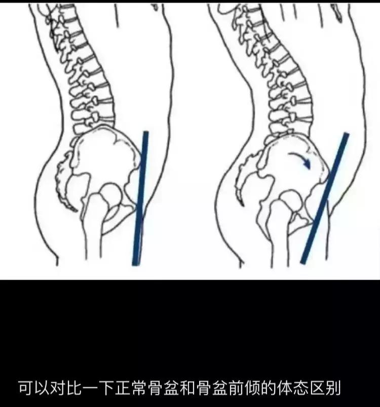 肚子突出屁股后翘正常吗,肚子大腰弯屁股翘怎么矫正