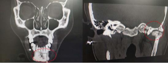 女司机下巴撞护栏情况,女司机撞栏杆下巴脱臼