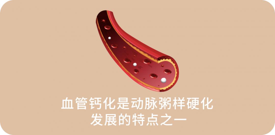 血管钙化如何治疗效果好呢,补钙太多导致血管钙化