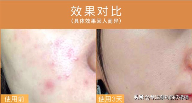 片仔癀的祛痘产品怎么样,片仔癀祛痘贴评价