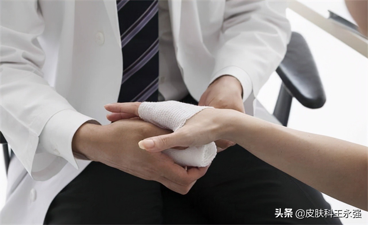 汗疱疹瘙痒严重怎么办,汗疱疹奇痒无比如何缓解