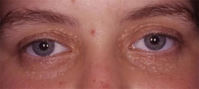 脂肪粒白头怎么去,脂肪粒去除小妙招皮肤