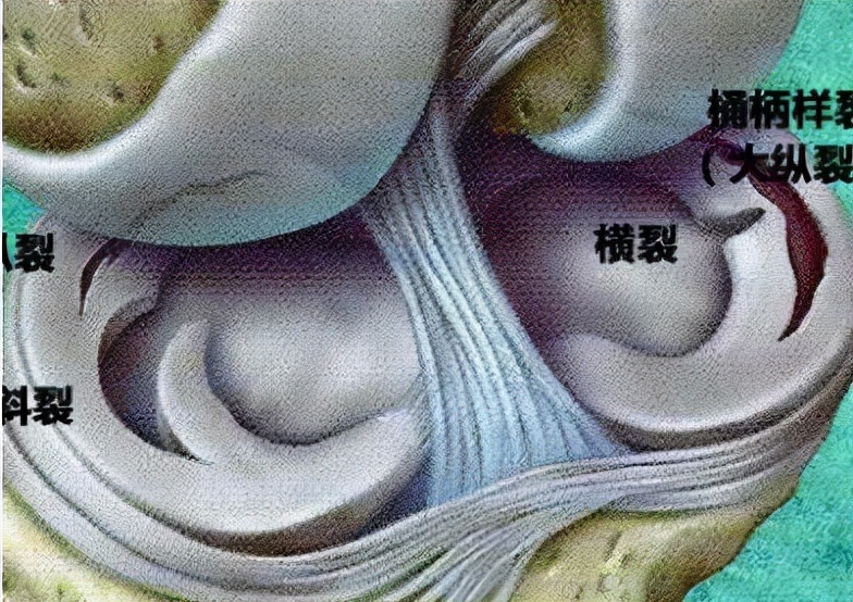 关节镜的适应症是什么,关节镜操作流程及注意事项